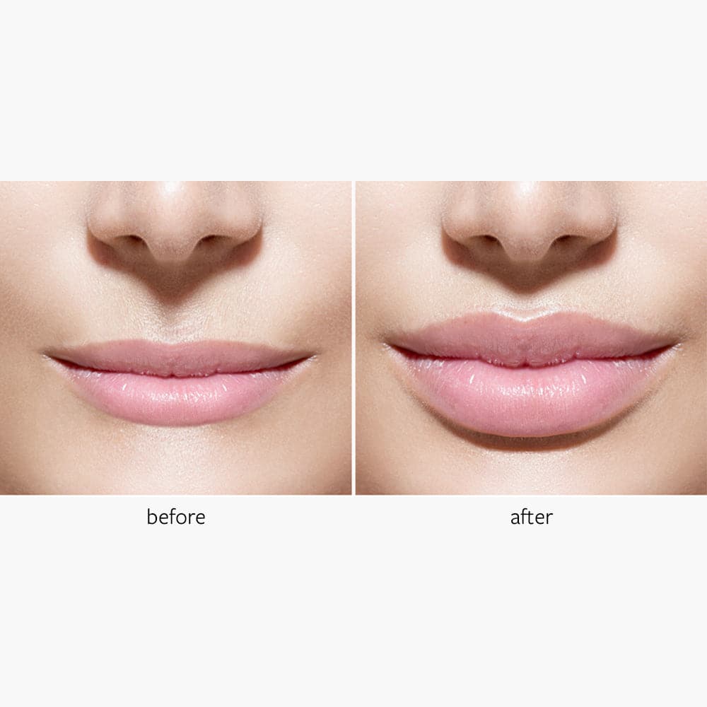 Freezeframe Lip Injection 10ml